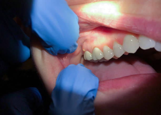 Best Emergency Wisdom Teeth Removal in Cherry Creek, CO